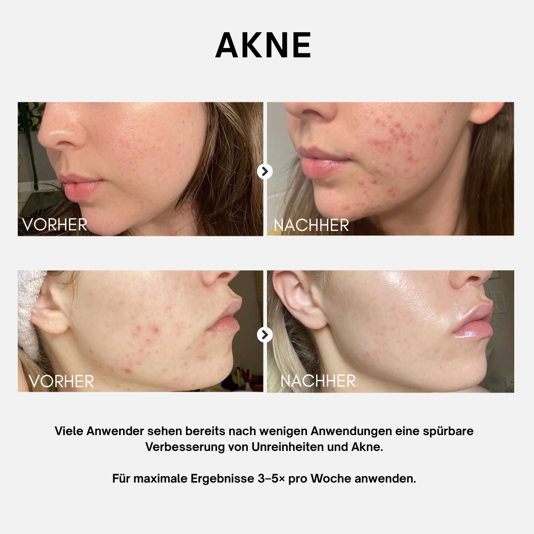 LightPlasma LED Therapie Gesichtsmaske