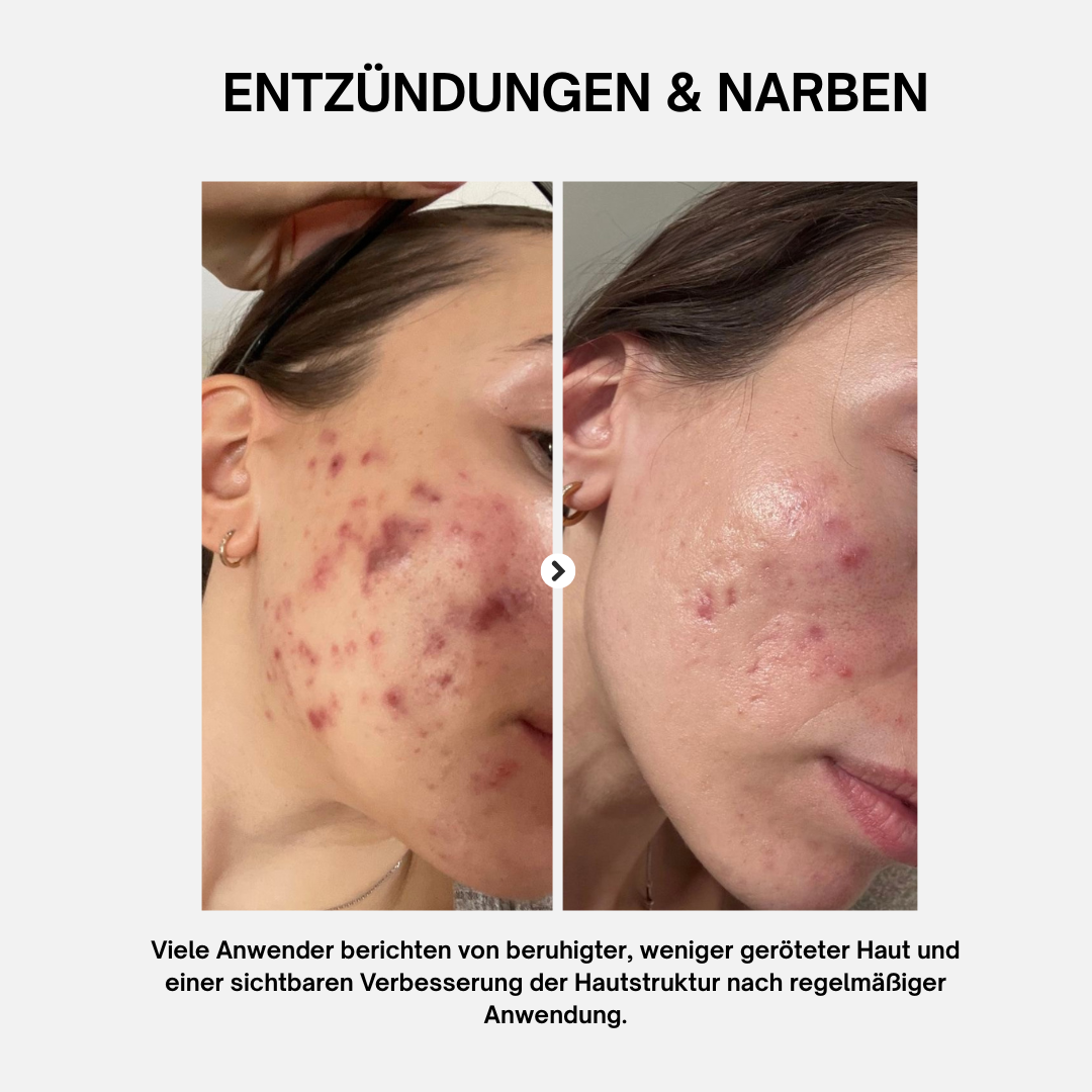 LightPlasma LED Therapie Gesichtsmaske